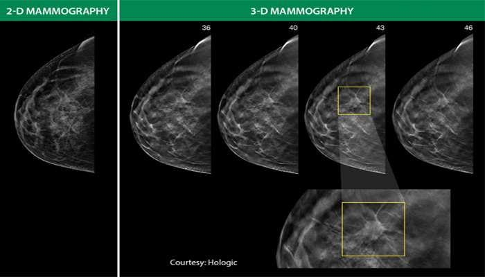 Lexington Medical Center Begins 3D Mammography